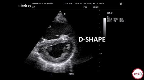 d sign pulmonary embolism.